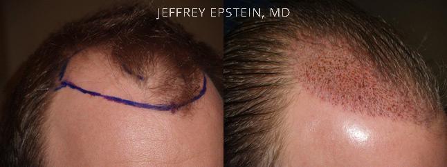 Hair Transplants for Men Before and after in Miami, FL, Paciente 39021