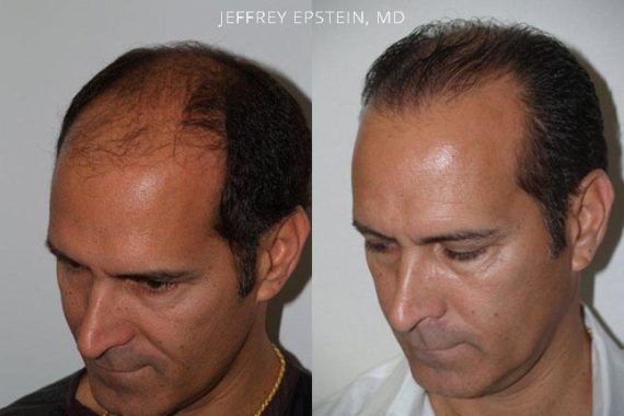 Hair Transplants for Men Before and after in Miami, FL, Paciente 39030