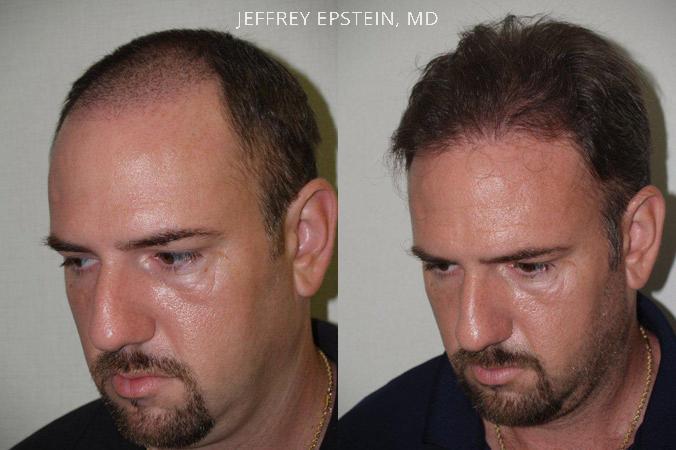 Trasplante de Pelo en Hombres Antes y después en Miami, FL, Paciente 81349