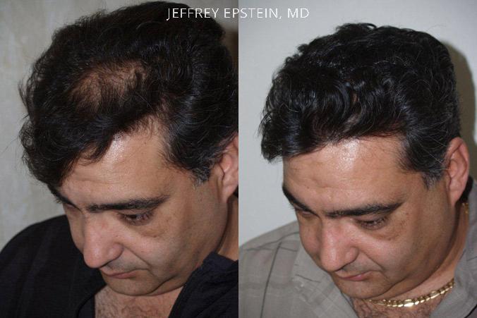 Hair Transplants for Men Before and after in Miami, FL, Paciente 39036