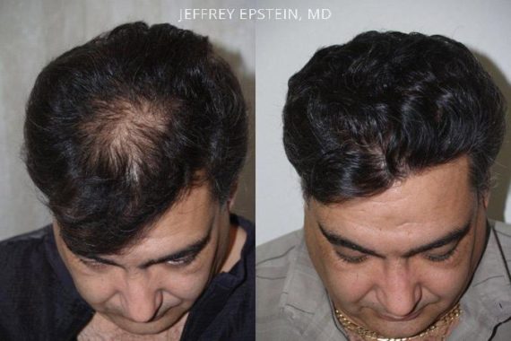 Hair Transplants for Men Before and after in Miami, FL, Paciente 39036