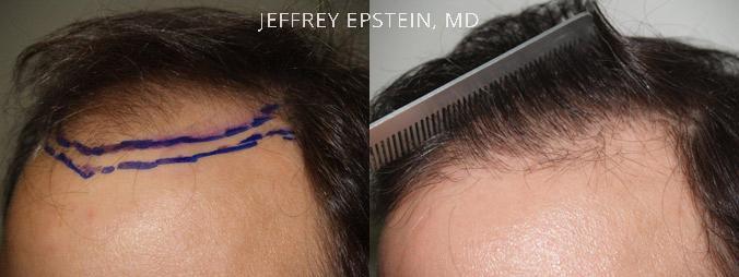 Hair Transplants for Men Before and after in Miami, FL, Paciente 39041