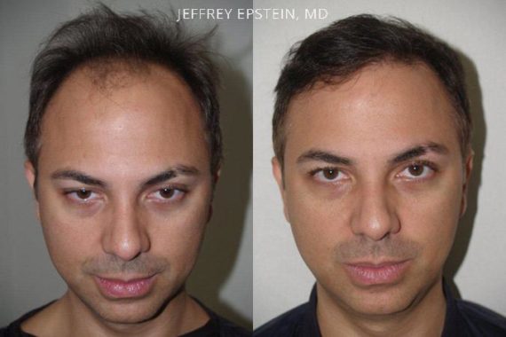 Trasplante de Pelo en Hombres Before and after in Miami, FL, Paciente 81297