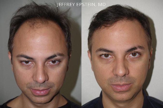 Trasplante de Pelo en Hombres Antes y después en Miami, FL, Paciente 81297