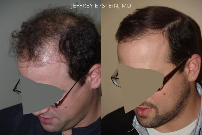 Hair Transplants for Men Before and after in Miami, FL, Paciente 39051