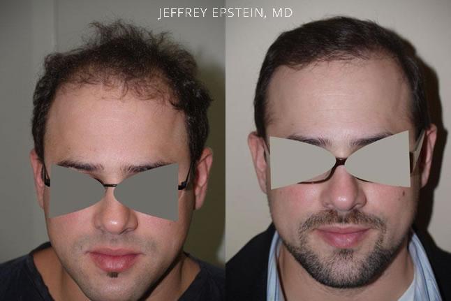 Hair Transplants for Men Before and after in Miami, FL, Paciente 39051