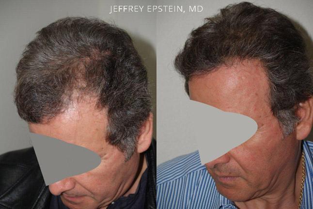 Hair Transplants for Men Before and after in Miami, FL, Paciente 39056