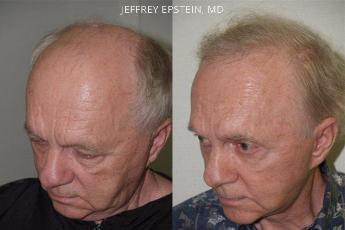 Hair Transplants for Men Before and after in Miami, FL, Paciente 39060