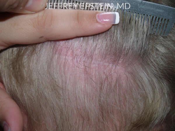 Hair Transplants for Men Before and after in Miami, FL, Paciente 39060