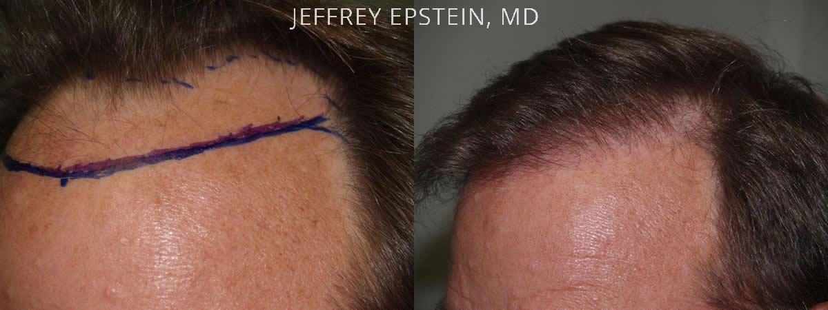 Hair Transplants for Men Before and after in Miami, FL, Paciente 39070