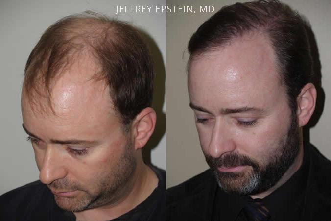 Hair Transplants for Men Before and after in Miami, FL, Paciente 39075