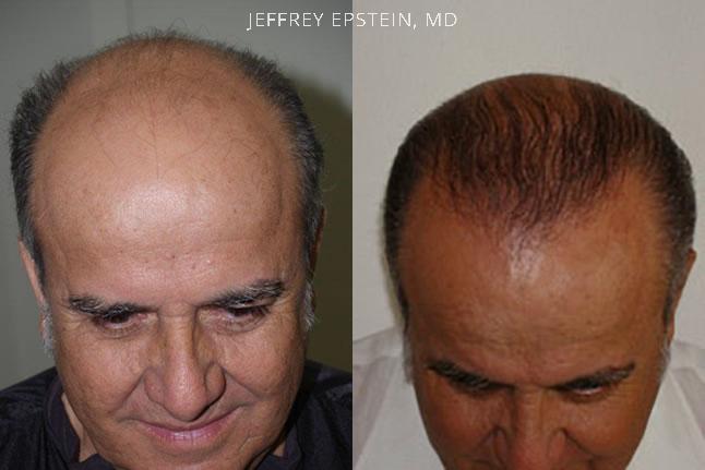 Hair Transplants for Men Before and after in Miami, FL, Paciente 39084