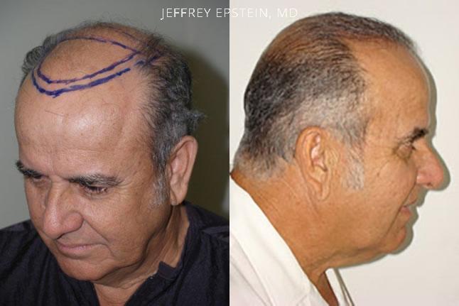 Hair Transplants for Men Before and after in Miami, FL, Paciente 39084