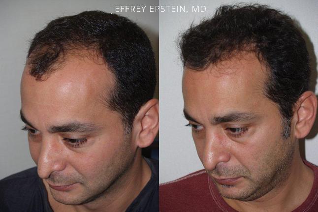 Hair Transplants for Men Before and after in Miami, FL, Paciente 39091