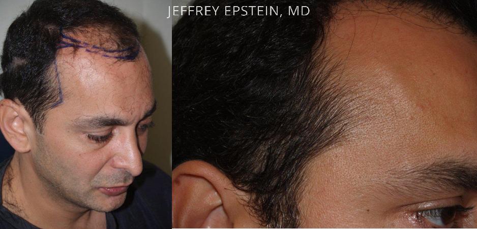 Hair Transplants for Men Before and after in Miami, FL, Paciente 39091