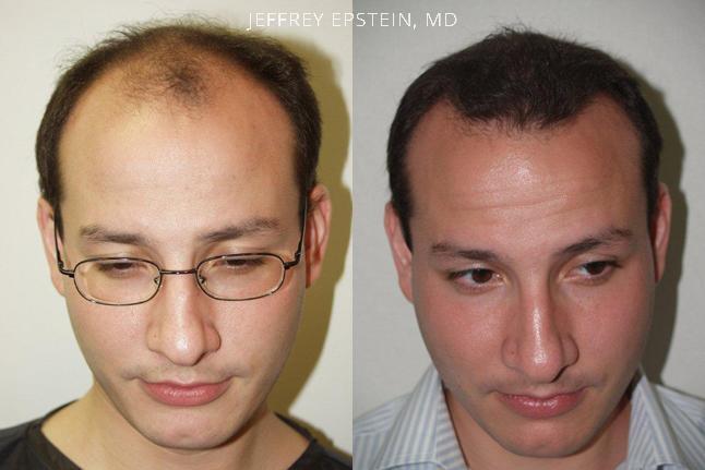 Hair Transplants for Men Before and after in Miami, FL, Paciente 39108