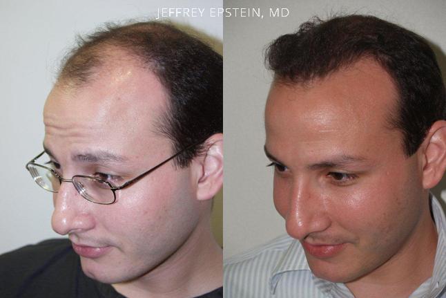 Trasplante de Pelo en Hombres Antes y después en Miami, FL, Paciente 80800
