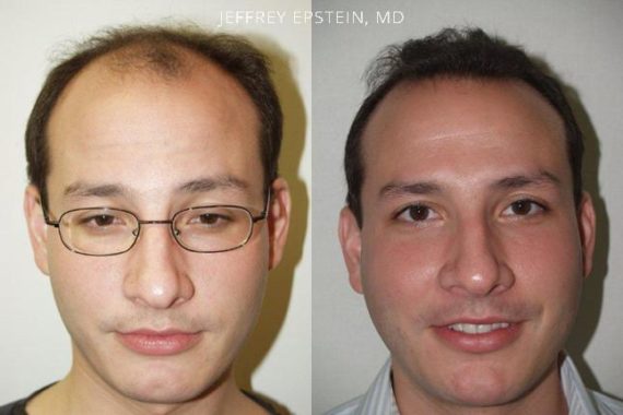 Trasplante de Pelo en Hombres Before and after in Miami, FL, Paciente 80800