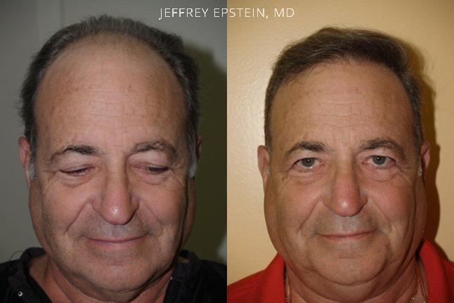 Hair Transplants for Men Before and after in Miami, FL, Paciente 39116