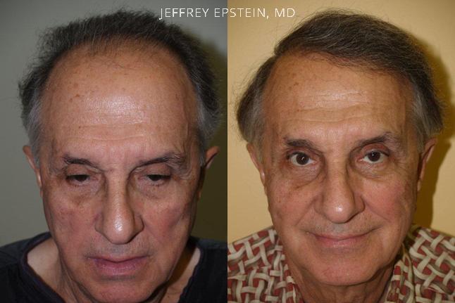 Hair Transplants for Men Before and after in Miami, FL, Paciente 39125