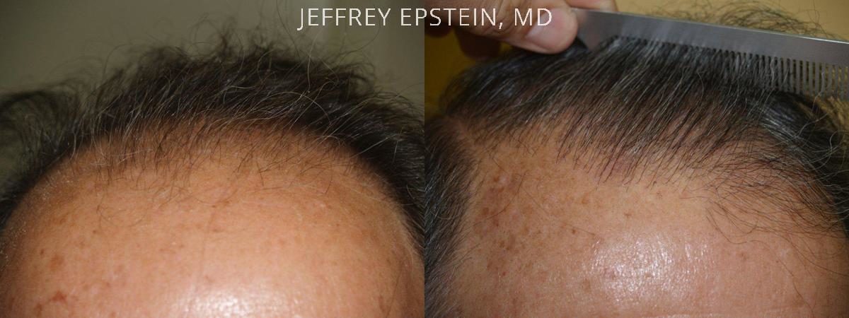 Hair Transplants for Men Before and after in Miami, FL, Paciente 39125