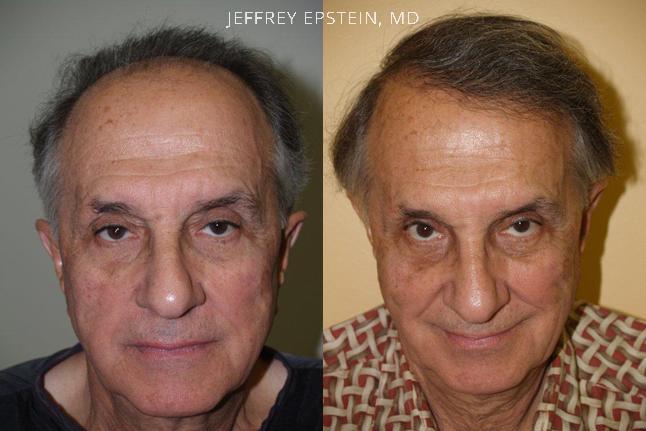 Trasplante de Pelo en Hombres Antes y después en Miami, FL, Paciente 80718