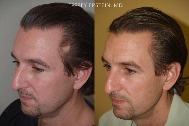 Hair Transplants for Men Before and after in Miami, FL, Paciente 39133