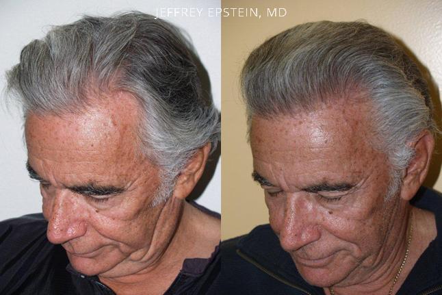 Hair Transplants for Men Before and after in Miami, FL, Paciente 39138