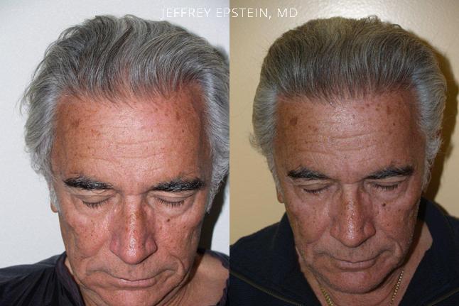Hair Transplants for Men Before and after in Miami, FL, Paciente 39138