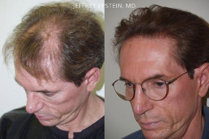 Trasplante de Pelo en Hombres Antes y después en Miami, FL, Paciente 80637