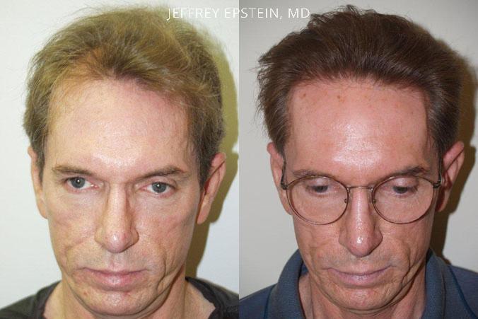 Trasplante de Pelo en Hombres Antes y después en Miami, FL, Paciente 80637