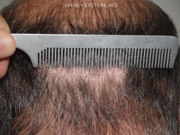 Hair Transplants for Men Before and after in Miami, FL, Paciente 39151