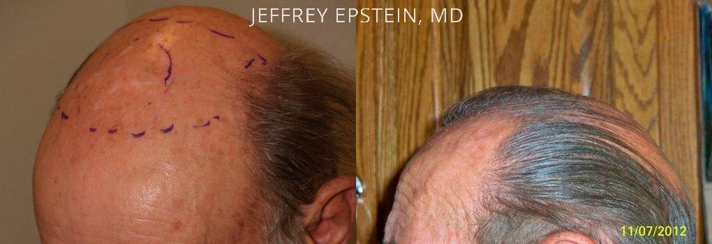 Hair Transplants for Men Before and after in Miami, FL, Paciente 39157