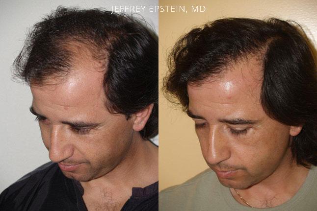 Hair Transplants for Men Before and after in Miami, FL, Paciente 39162