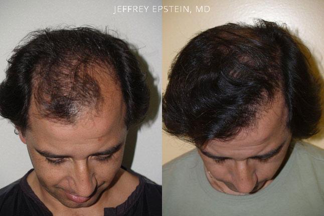 Hair Transplants for Men Before and after in Miami, FL, Paciente 39162