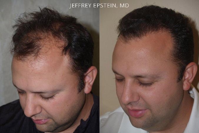 Hair Transplants for Men Before and after in Miami, FL, Paciente 39168
