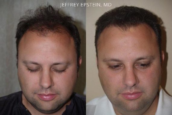 Hair Transplants for Men Before and after in Miami, FL, Paciente 39168