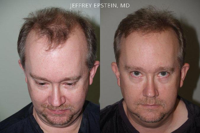 Hair Transplants for Men Before and after in Miami, FL, Paciente 39192