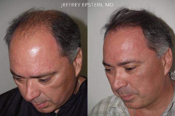 Hair Transplants for Men Before and after in Miami, FL, Paciente 39199
