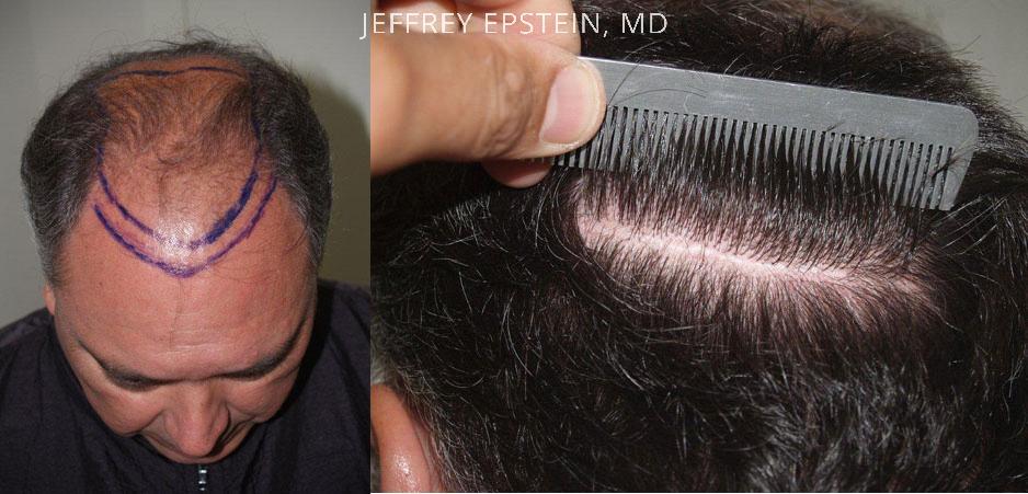 Hair Transplants for Men Before and after in Miami, FL, Paciente 39199