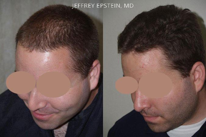 Hair Transplants for Men Before and after in Miami, FL, Paciente 39208