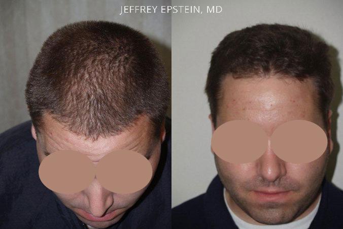 Hair Transplants for Men Before and after in Miami, FL, Paciente 39208