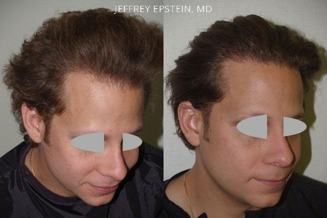 Hair Transplants for Men Before and after in Miami, FL, Paciente 39215