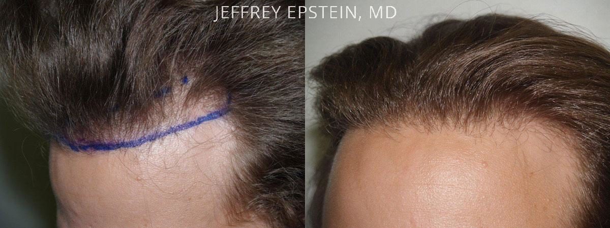 Hair Transplants for Men Before and after in Miami, FL, Paciente 39215