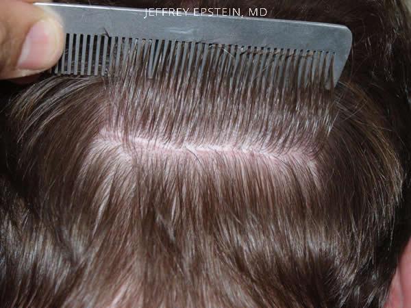 Hair Transplants for Men Before and after in Miami, FL, Paciente 39223