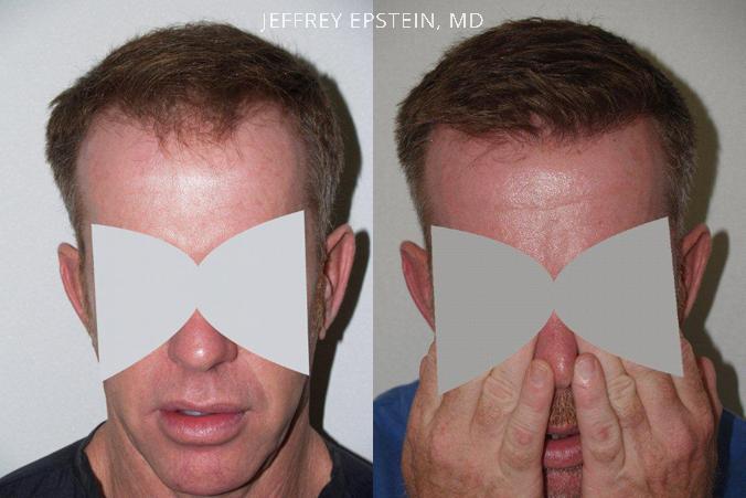 Hair Transplants for Men Before and after in Miami, FL, Paciente 39234