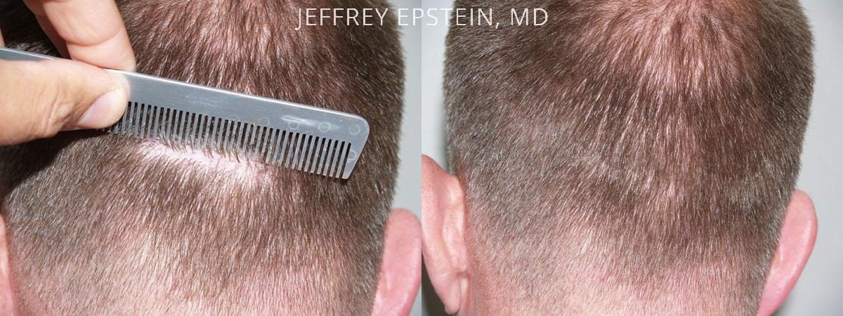 Hair Transplants for Men Before and after in Miami, FL, Paciente 39234