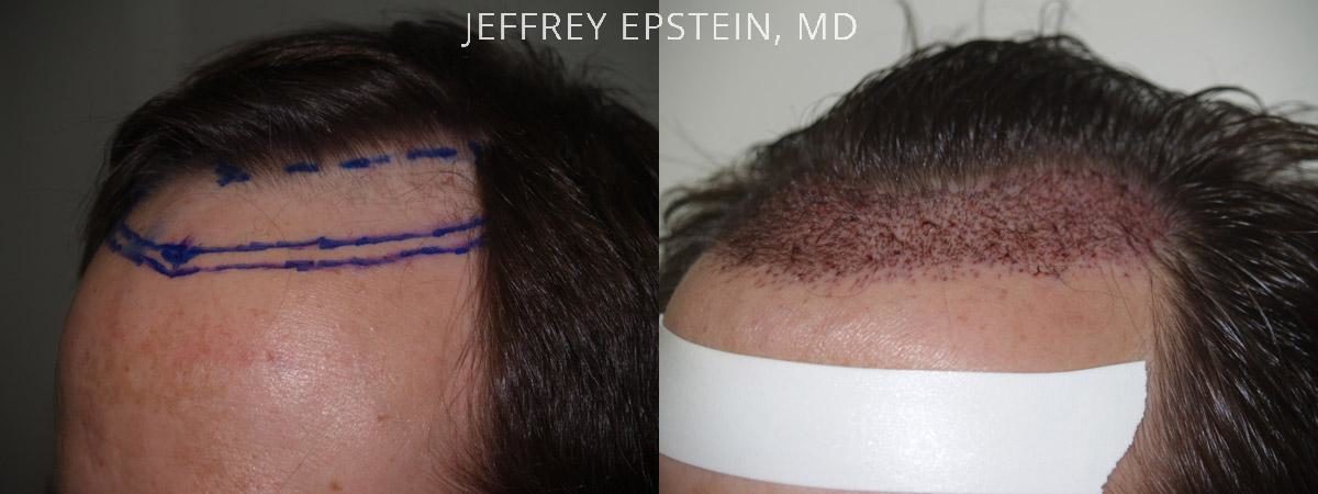 Hair Transplants for Men Before and after in Miami, FL, Paciente 39241