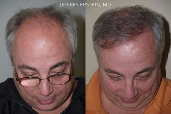 Trasplante de Pelo en Hombres Before and after in Miami, FL, Paciente 80145