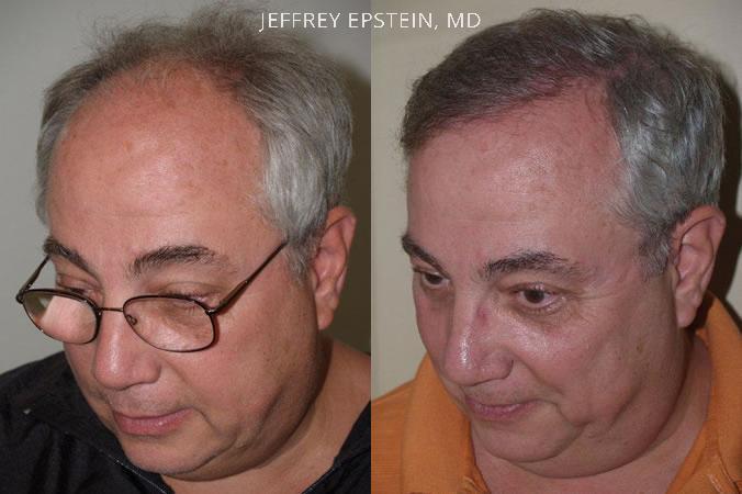 Hair Transplants for Men Before and after in Miami, FL, Paciente 39244